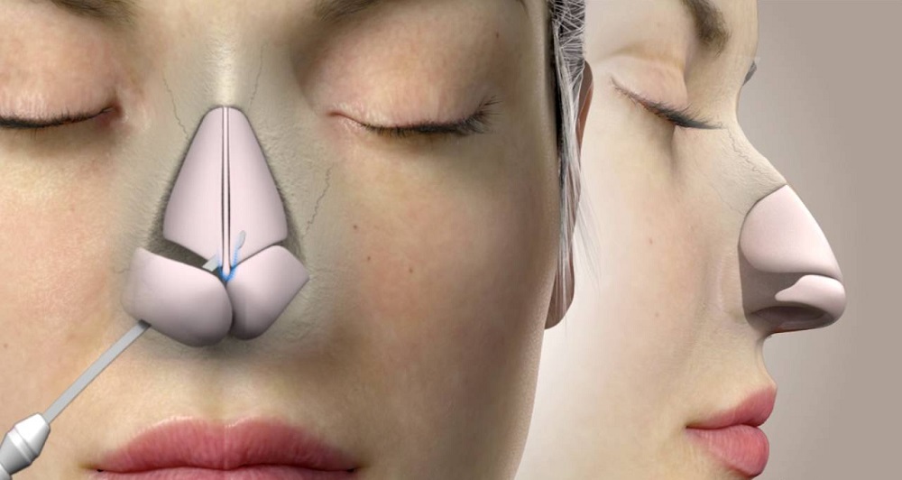 The Conventional Rhinoplasty And The Osteotomy Nose Job