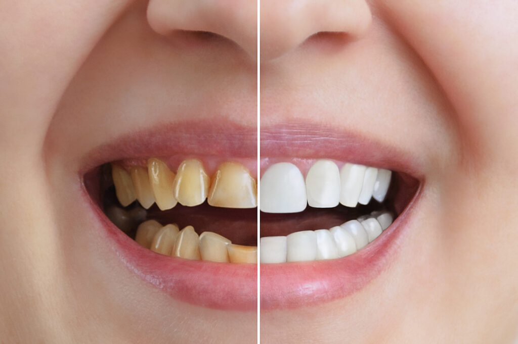 Teeth Whitening– How Many Shades Brighter Can You Go?