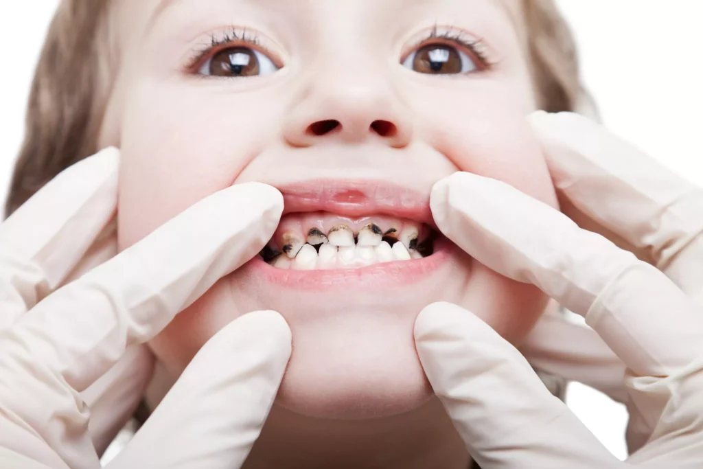 Early Signs of Tooth Decay in Kids and How to Address Them